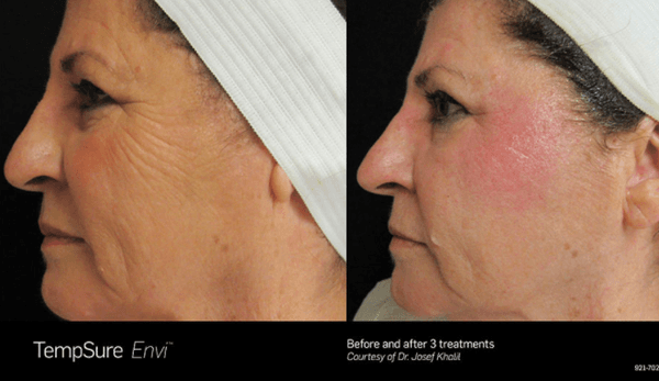 TempSure Envi Before and After!