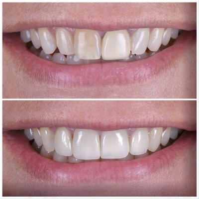 Smile Makeover