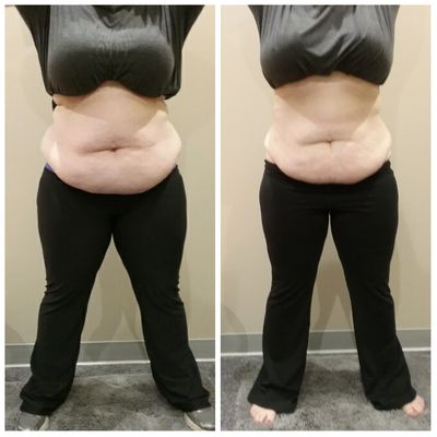 Results of Tummy Pouch reduction after treatment package - Laser Lipo