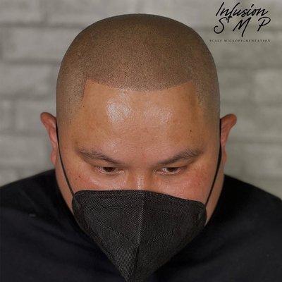 Scalp Micropigmentation 3 session Results