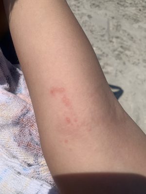 Multiple bed bug bites on my son