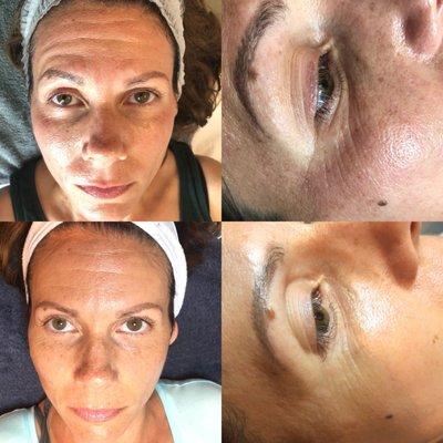 Microneedling after 3 weeks