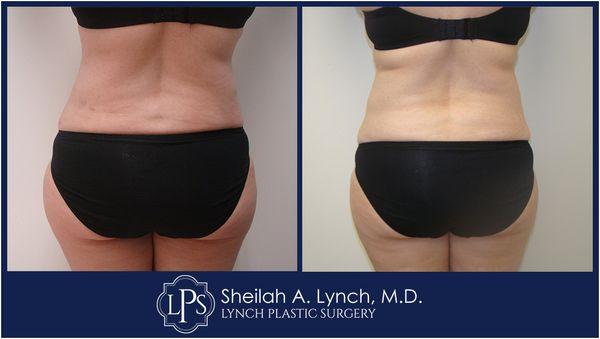 Lipo 360 Before & After Patient Receive an expert opinion from Board Certified Plastic Surgeon  Dr. Sheilah A. Lynch.