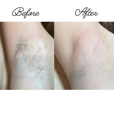 Have you been Sugared? Natural Hair Removal that removes unwanted hair on any part of the body!