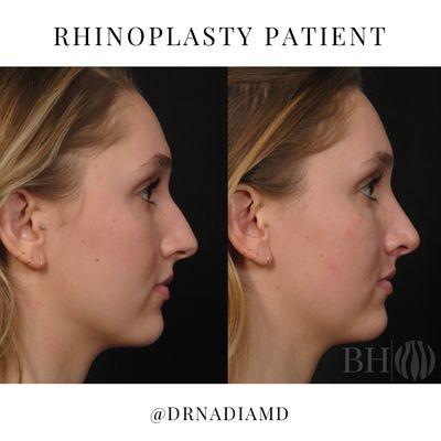 Rhinoplasty