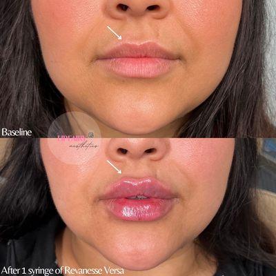 Before and after lip filler using Revanesse Versa.