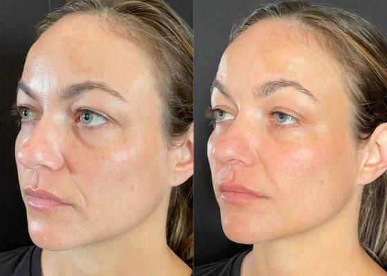 Dermal filler to mid face, lips and smile lines