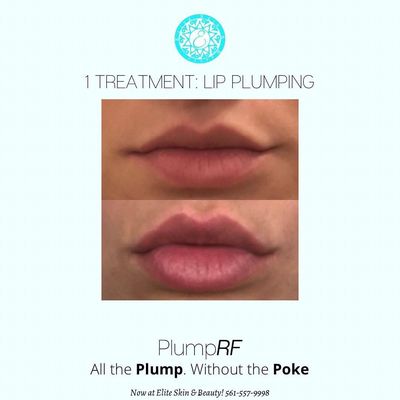 Plump RF FDA approved to plum and restore lips without any injections.