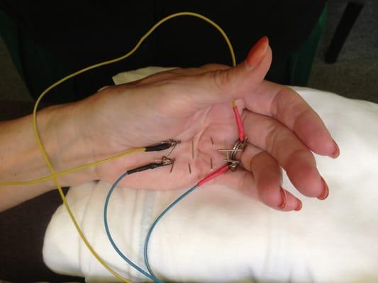 Electrostim Acupuncture for Dupuytren's