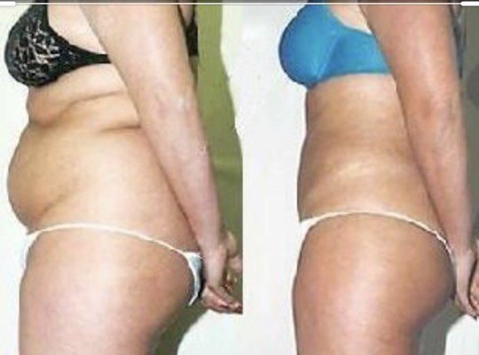 Before and After 8 Laser lipo and Cavitation