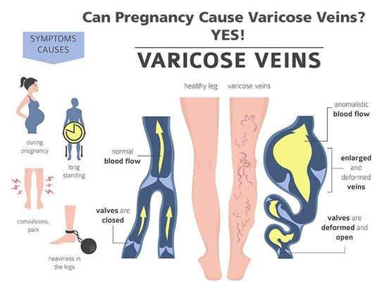 Did you know that Pregnancy can cause varicose Veins?  Look at these symptoms and call us here at IVVC for an appointment.  810-606-1660