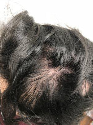 alopecia areata After steroid injection