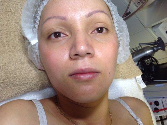 After Pigmentacion Treatment