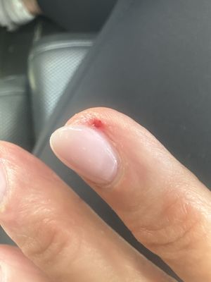 Cuticle cut and bleeding