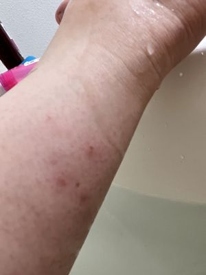 bed bug bites