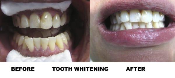 Teeth Whitening