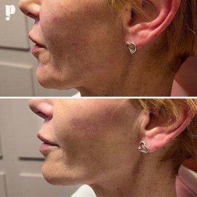 Jaw Filler Treatment