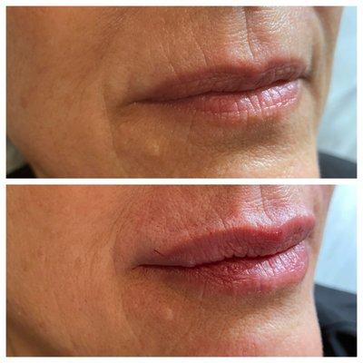 Lip filler with Restalyn Refyne.