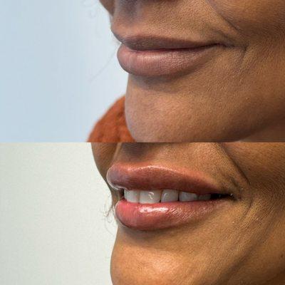 At District Laser we love luscious, hydrated lips. Book your consult today.