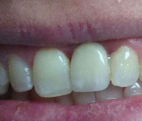 Restored missing  Tooth #9 with Implant Crown