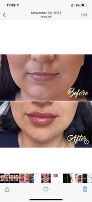 Lips filler with Juvederm ultra