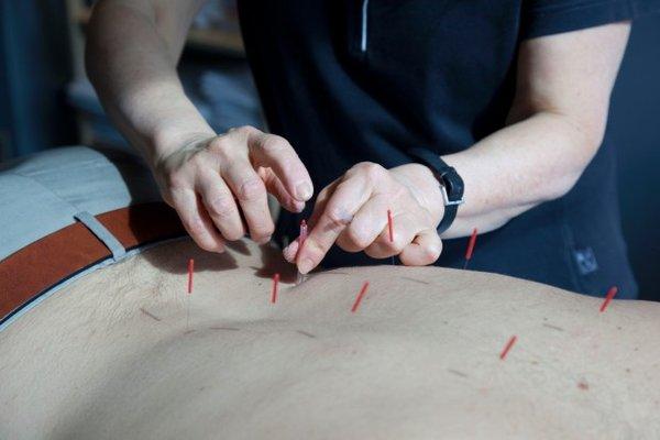 Acupuncture