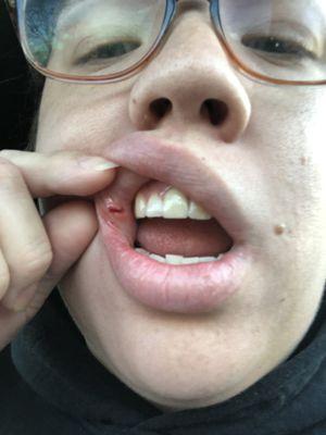 The dentist sliced my lip open because she's an idiot.