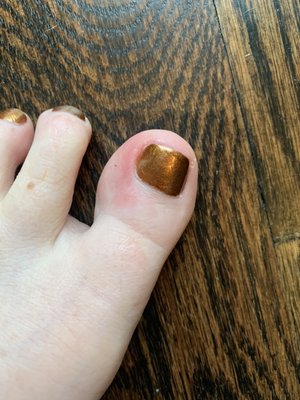 Pedicure - toenail cut and foot now swollen and red