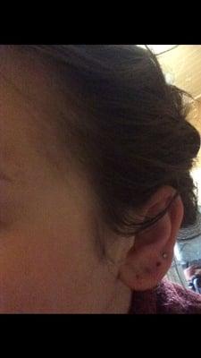 My inflamed and infected ear eating my piercing.