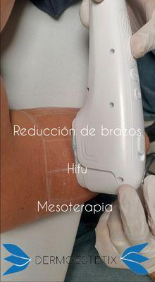 REDUCCION DE GRASA LOCALIZADA BRAZOS HIFU