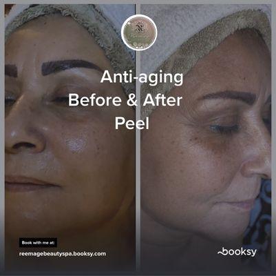 Anti aging treatment Before & Aftet