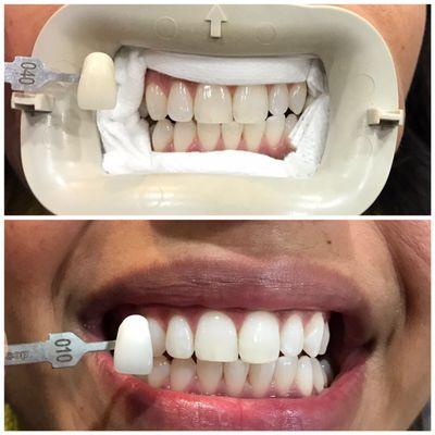 Brighter smile! Before & After