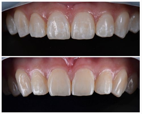 Resin Infiltration done to remove white spots on teeth