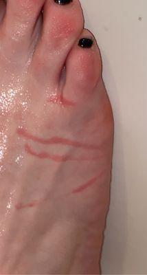 Burn marks on foot/skin