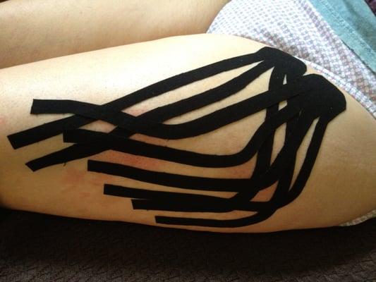 Kinesio tape for bruising