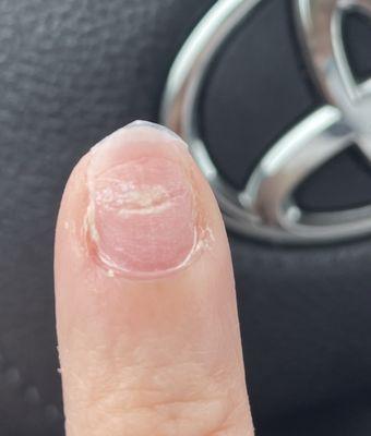 gauge right in the middle of my nail from digging the cuticle clipper in and tearing off layers of nail crack was down to the nail bed