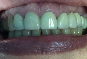 Dental Crowns making Beautiful Smiles