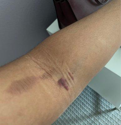 Vein bruising