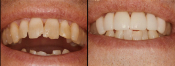 Porcelain Laminates to correct chipped and crooked teeth.