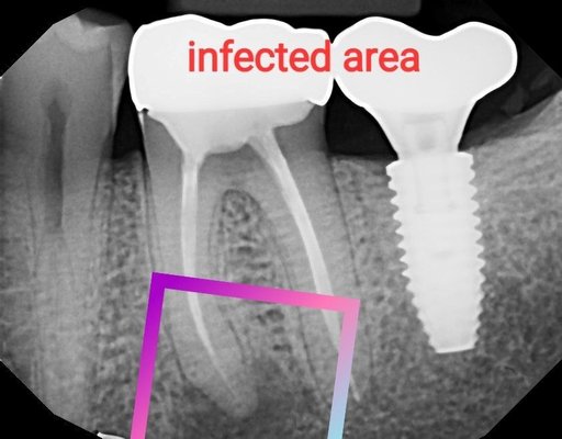 The squre shows the infection