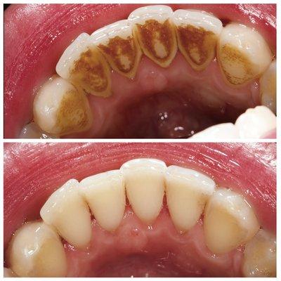 FULL MOUTH DEBRIDEMENT ARCH UPPEN AND LOWER / LIEMPIEZA PROFUNDA COMPLETA ARRIBA Y ABAJO.