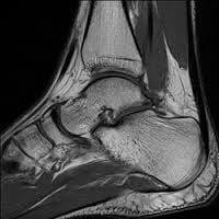 MRI of Ankle