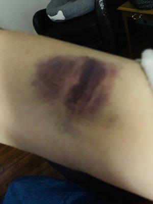 Bruise left after blood draw from Lifespan LAN on Smith Street in North Providence.