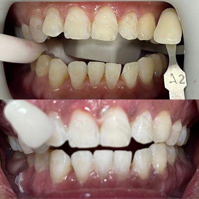 Zoom one-hr in-office teeth whitening before and after photo. Don't wait any further...call us and have that brighter smile in an hour ;)