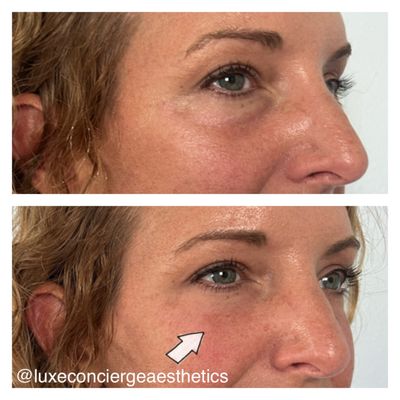 Tear trough dermal filler