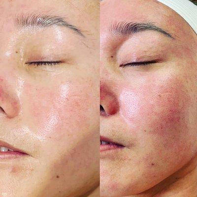 Hydra Glow Facial