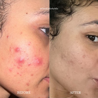 Acne bootcamp before & after