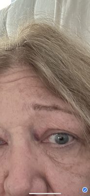 Eye bruise obtained after put under anesthesia.