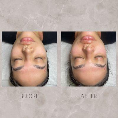 Custom Facial