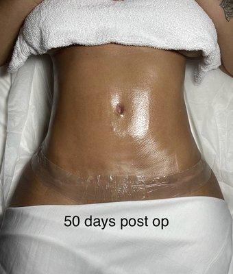 Tummy tuck - 50 days post op